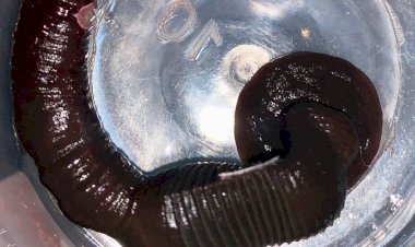 नाक में एक महीने से चिपकी थी जिन्दा जौंक