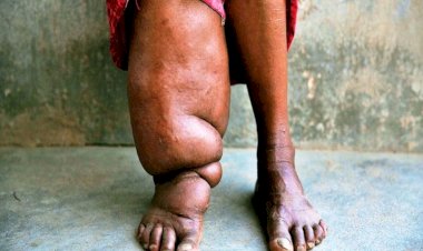 जालौन में फाइलेरिया से सबसे ज्यादा प्रभावित गांव है सरावन