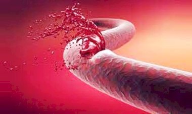 अनुवांशिक बीमारी है हीमोफीलिया, चोट लगने पर हर बार लगता है इंजेक्शन