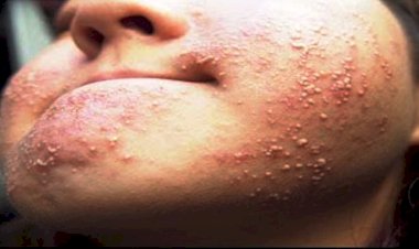 बांदा : चेहरे पर दाने निकलने से कई जगह टूटा शादी का रिश्ता, परेशान युवती ने उठाया खौफनाक कदम