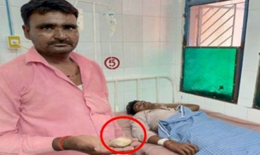 हमीरपुर जिला अस्पताल के मरीज की पेशाब की थैली से निकाली 58 मिमी. की पथरी, सर्जन और टीम भी चौकें